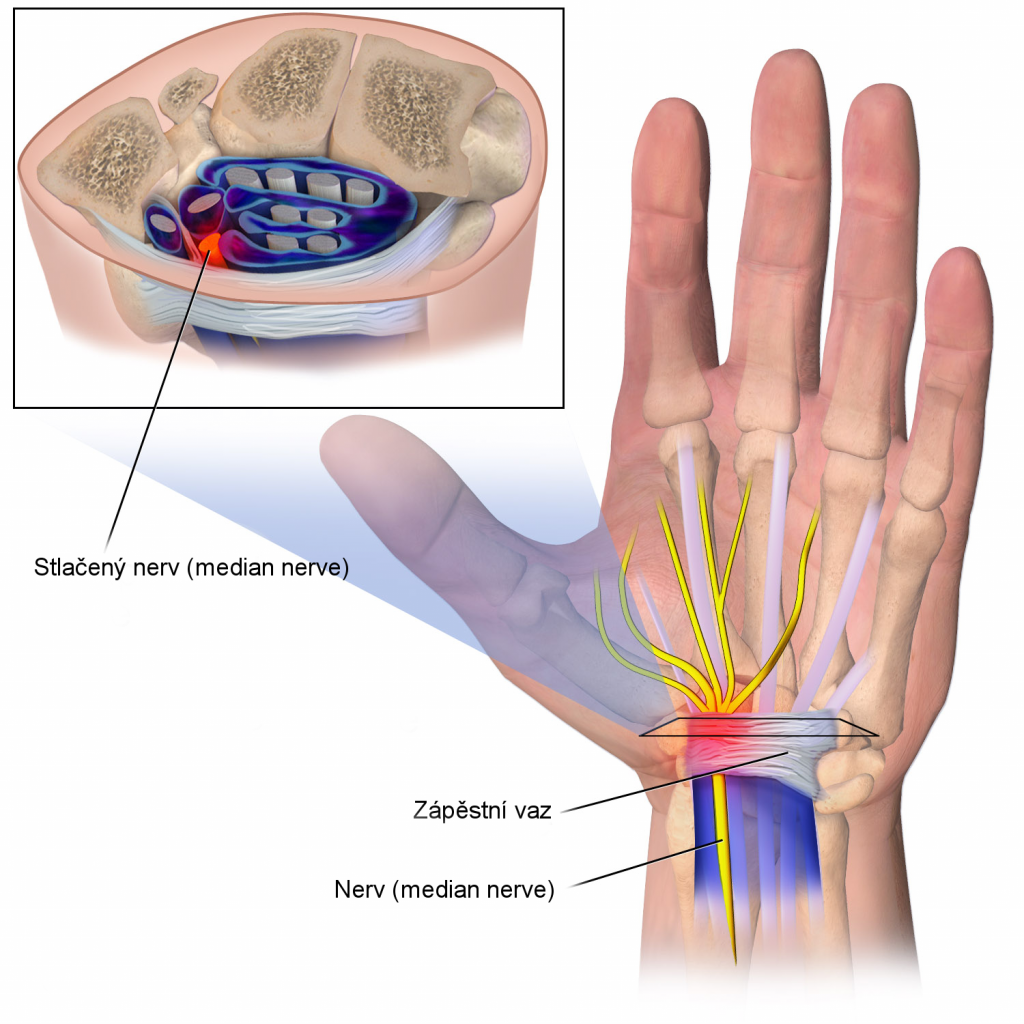 Carpal_Tunnel_Syndrome